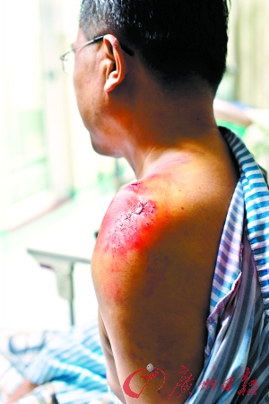 老师身挡飞车救女孩致左肩粉碎骨折 称本能反应